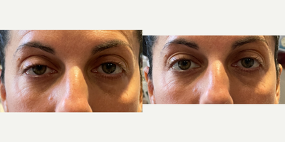 35-44 year old woman treated with Drop N Lift - Patient was inquiring about a non surgical option to lift her eyelid. Patient was instilled with Drop N lift in the right eye and about 3 minutes later, as you can see, the eyelid was lifted dramatically. This drop is to be used once a day and to be monitored by an MD every 3 months.