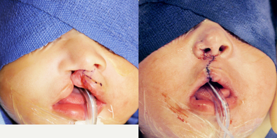 Medical Mission Work Cleft Lip and Nose Repair - One of my many passions is helping those in need. I like to travel two a year with doctors without borders and give back. This from my medical mission work and is one of my many motivations to why I do what I do.