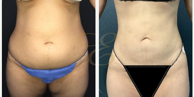 Woman treated with Vaser Liposuction - Woman treated with Vaser Liposuction