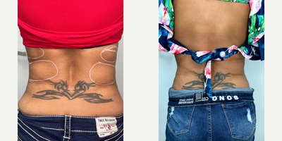 35-44 year old woman treated with i-Lipo - Lipo Shots back area