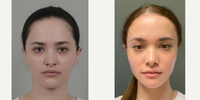 18-24 year old woman treated with Cheekbone Reduction, Forehead Reduction, Rhinoplasty, V Line Surgery - .