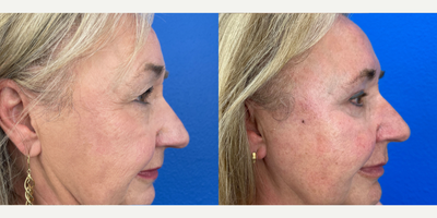 65-74 year old woman treated with Eyelid Surgery, Double Eyelid Surgery, Brow Lift - Patient had bi-lateral upper and lower blepharoplasty and brow pexy