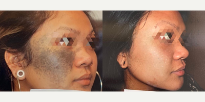 Woman treated with Pulsed Dye Laser - Pulse dye laser used to remove birthmark. The patient received approximately 12 treatments over a two year span.