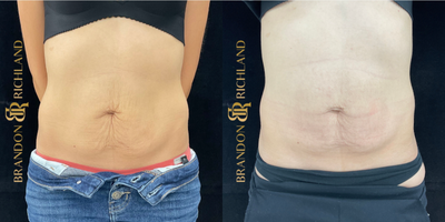 35-44 year old woman treated with Morpheus8 - Turning back the clock on this super star mom after having 2 pregnancies with 10lb babies! Can you believe this was after only 1 treatment?