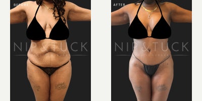 40 year old woman treated with Mommy Makeover: Tummy Tuck and Lipo 360. - 40 years old female s/p abdominoplasty and lipo 360. Weight: 194Height: 6'0BMI: 25.95Liposuction: Abdomen/flanks: 1500mL  Back:550mLProcedure taken:Mommy Makeover: abdominoplasty + Lipo 3606 Months post-op