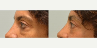 Tightening and collagen regeneration of under-eye area with Tripollar treatment - Under-eye puffiness was significantly reduced after one Tripollar treatment.  This 48 year old patient is seen immediately after her first treatment.
