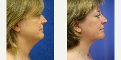 35-44 year old woman treated with Chin Liposuction - This patient was unhappy with the excess skin and fat under her chin.The doctorperformed neck liposuctionto get rid of the excess fat under her chin, giving her a better profile.