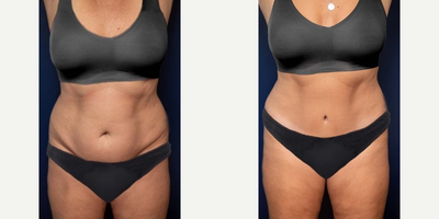 Woman treated with Tummy Tuck - When a professional athlete in her fifties wants her belly restored after having children, a good option is a high lateral tension abdominoplasty (tummy tuck) which will place her muscles back in position, lift the front of her legs, and even help position her pelvis in the pre-partum state. She is also pleased with the natural shape of her belly button and her narrow waist. No liposuction was used!