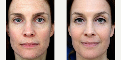 35-44 year old woman treated with Clear & Brilliant - Clear + Brilliant, Female Results