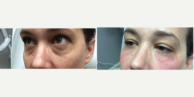 35-44 year old woman treated with Revanesse Versa Dark Circles Under Eye Treatment - 1 ML Revanesse Versa