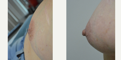 55-64 year old woman treated with microincision for retracted/inverted nipples - A woman in her later 50s who has always been bothered by retracted nipples, also called inverted nipples. The severity of nipple retraction has been graded by Han and Hong as Grade I: the nipple can be pulled out easily and maintains its projection well without traction. Grade II: the nipple can be pulled out but not as easily as grade I and it has difficulty maintaining its position. Grade III: severely inverted and retracted, and is very difficult to pull out. The nipple ducts are shot and severely retracted and are pulling in on the nipple like the lines on a parachute. In this patients case she was Grade III on her right, and Grade II on her left. She is shown before and again, 6 weeks after closed treatment of the inverted nipples through a micro-incision procedure performed under local anesthesia in the office.Her nipple sensation remains normal.