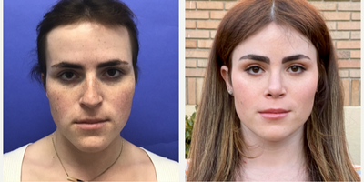 Patient treated with Facial Feminization Surgery, Transgender Facial Feminization Surgery, Rhinoplasty, Septoplasty, Cheek Augme - 25 to 34 year-old female patient is 1 year post-op from Facial Feminization surgery. Her procedures included: Forehead Lift, Hairline Lowering, Orbital Bony Contouring, Septorhinoplasty (open) with Cartilage Grafts and Weirs, Cheek Implants (small combined), 2 cc Voluma to Medial Cheeks, Chin Reduction and Contour, Thyroid Cartilage Shave, Intranasal Lip Lift with Fat Augmentation, Soft Tissue to Nasolabial Folds, and 300 Micrografts to the Fronto Temporal Recessions.