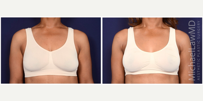 35-44 year old woman treated with Sientra Breast Implants - Breast augmentation. Follow-up photos taken 1 month after the procedure.