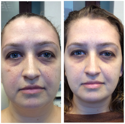 25-34 year old woman treated with PicoWay - This patient was treated with two PicoWay and PicoResolve laser treatments.