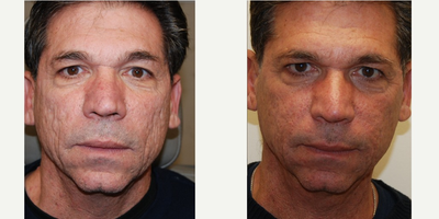 55-64 year old man treated with Silikon 1000 for volume replacement and acne scarring. - These photos demonstrate permanent improvement in acne scarring using Silikon-1000, an off-label filler for permanent results. Two, no downtime treatments were performed at monthly intervals in our kind patient. Injections were both deep to restore cheek volume, and superficial to fill his scars. You can see natural looking, youthful improvement without the expense and downtime often associated with deep resurfacing procedures.