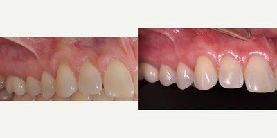 35-44 year old woman treated with Pinhole Surgical Technique - Gum recessions on three upper front teeth ##6,7,8 were treated with Pinhole technique. No palatal tissue used, minimal discomfort reported by the patient and an amazing functional and esthetic result observed - 6 month follow up.