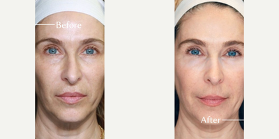 Woman treated with Renuva - Woman treated with Renuva