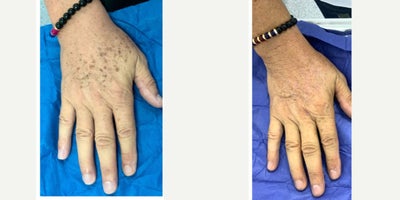 55-64 year old man treated with Fractional Laser - Qswitched Laser for solar melanosis.