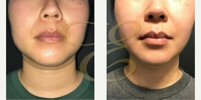Woman treated with Vaser Liposuction, Renuvion - Woman treated with Vaser Liposuction, Renuvion