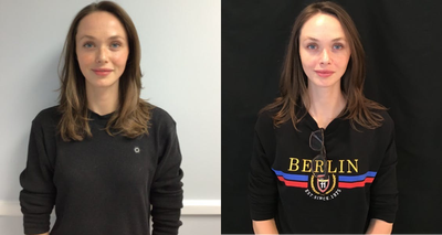 25-34 year old woman treated with Dermalinfusion - Client came in for dermalinfusion treatment and was given bleaching cream to prepare for Pico laser to reduce melasma. She will return to the center in a few weeks for the Pico laser treatment.