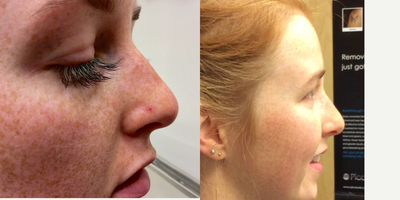 25-34 year old woman treated with Vein Treatment - Two treatments four weeks apart were done, to target the vein on patient's noes. VeinGogh was the treatment that was used and our patient was very happy with the results .