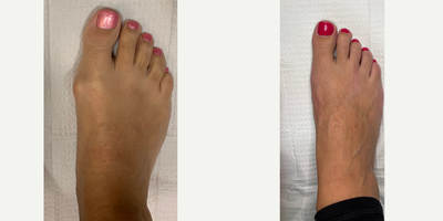 25-34 year old woman treated with Bunion Surgery - The bunion was corrected with an Austin Bunionectomy, along with a neuroma resection of the 3rd interspace. The patient has returned to wearing all her shoes, including all her high heels, she is accustomed to wearing with no pain. She has returned to all of her activities with no limitations.