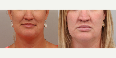 Filler treatment - Meaningful Beauty +&nbsp;Filler Treatment to the lips