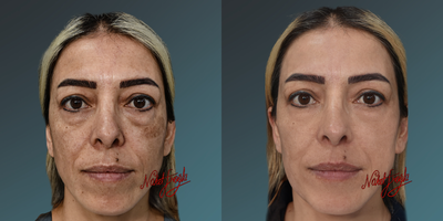 35-44 year old woman treated with Pulsed Dye Laser - In skin rejuvenation, laser protocols with various wavelengths now offer different solutions for treating spots and scars. Considering the ratio of skin issues such as spots, veins, keratosis, freckles, warts, moles, etc., along with skin color, age, and environmental damage.