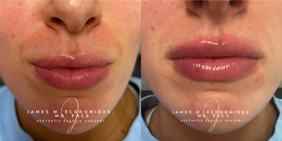 Lip Fillers - Lip Fillers