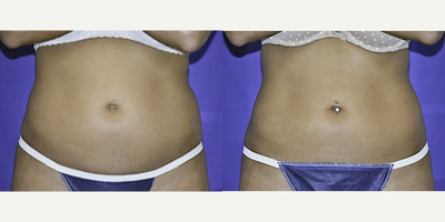 35-44 year old woman treated with Liposonix - 35-44 year old woman treated with Liposonix