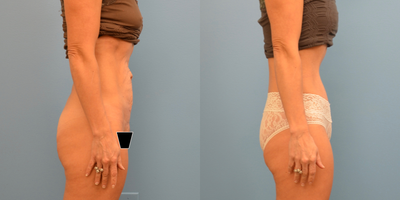 35-44 year old woman treated with Tummy Tuck - Abdominoplasty