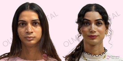 18-24 year old woman treated with Facial Feminization Surgery, Forehead Reduction, Rhinoplasty - The patient underwent a comprehensive facial feminization journey at Olmec, including Facial Feminization Surgery (FFS), TrueShape forehead reduction, feminizing rhinoplasty, and Voice Feminization Surgery. Each procedure was carefully planned to create refined, naturally feminine features while maintaining facial balance and individual character. The overall outcome is natural, harmonious, and beautifully proportioned, reflecting Olmecs focus on personalized care and aesthetically balanced results.Procedures:Type - K Forehead Feminization (lowering of Hairline Lowering, Eyebrow lift, 3-D Contouring of Bones, Widening the upper lateral orbit, Frontal sinus setback), trichophytic closure (to camouflage the scar), Feminizing Rhinoplasty- Tip-plasty, Dorsal contouring/scooping, Narrowing the dorsum and B/L Alar-plasty (nostrils reshapingVoice feminization surgery (CTA)