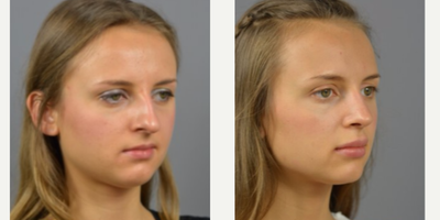 18-24 year old woman treated with Rhinoplasty - 23 year old with nasal hump and bulbous tip.