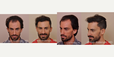 35-44 year old man treated with ARTAS Robotic Hair Transplant - 30 year old man following his hair restoration procedure using the ARTAS Robotic Hair Transplant Surgical System.