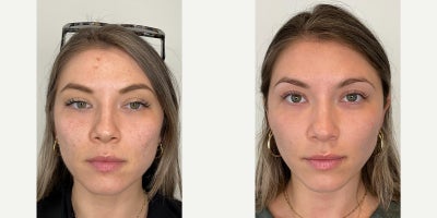 25-34 year old woman treated with Microneedling - Microneedling with SkinPen  Before & AfterTreatment: Microneedling with SkinPenSessions: Series of 4 treatments performed at Beverly Wilshire AestheticsFocus Areas: Acne scarring, uneven skin texture, redness, and overall skin toneBefore:Client presented with visible post-acne scarring, redness on the cheeks, enlarged pores, and uneven skin texture. There was also a healing blemish on the forehead and overall dullness to the skin.After:Following a series of SkinPen microneedling sessions, the clients skin shows a smoother, more refined texture with visible softening of acne scars and reduction in redness. Pores appear tighter, overall tone is more even, and the complexion looks brighter and healthier.Result:Microneedling with SkinPen stimulated natural collagen production, improving both texture and tone while enhancing skin clarity.