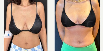 45-54 year old woman treated with Breast Reduction - In this procedure, excess fat, tissue, and skin are removed, reducing breast size. The recovery process varies from person to person and generally takes a few weeks.