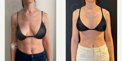 35-44 year old woman treated with Breast Lift - A breast lift, or mastopexy, is a surgical procedure designed to raise and reshape sagging breasts by removing excess skin and tightening the surrounding tissue. This procedure can restore a more youthful breast contour without significantly changing breast size.