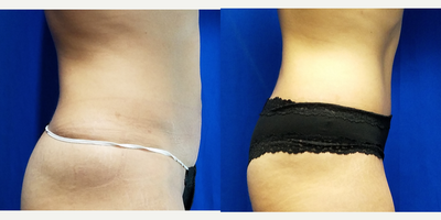 35-44 year old woman treated with Tummy Tuck - 41 year old female 2 months after a tummy tuck during a mommy makeover. She had a tummy tuck without a drain. Her height is 5 feet and her weight is 113 lbs. She has two children. Her lower vertical scar was removed during the tummy tuck.