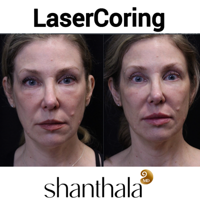 45-54 year old woman treated with Nonsurgical Facelift, Nonsurgical Neck Lift, Skin Rejuvenation, Skin Tightening - Can you get Facelift type of results with one session of Lasercoring and Removal of under eye fillers?