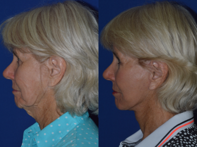 65-74 year old woman treated with Neck Lift - Deep plane face and neck lift under local anesthesia.