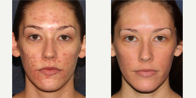 26 year old woman treated with Fraxel Repair - Acne and acne scars are treated using the Fraxel Re:Pair laser.