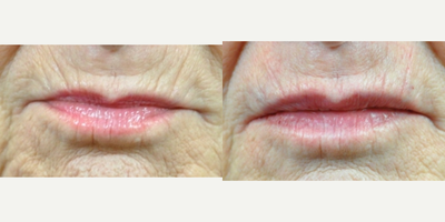 55-64 year old woman treated with Volbella - Volbella