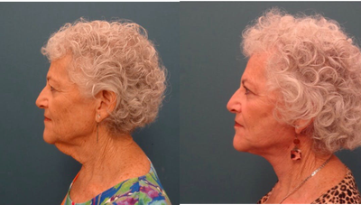 65-74 year old woman treated with Neck Lift - A neck lift procedure can tighten loose skin and give you a smoother, more defined silhouette that helps you look younger.