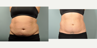 35-44 year old woman treated with SculpSure - 33-year-old female, BMI start 34, 12 weeks post treatment of  Abdomen