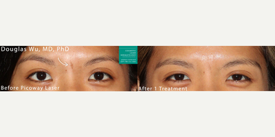 25-34 year old woman treated with PicoWay - PicoWay used to remove cafe au lait macule