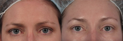 Botox to glabella and crow's lines - Botox was used to create brow lift without surgery in this young patient. There is a significant reduction in frown lines and forehead lines. After photo taken 2 weeks after initial treatment. Results usually last around 4 months.