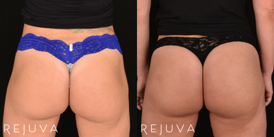Non-Surgical Butt Lift with Sculptra Aesthetic - Before and 1 Year After Non-Surgical Butt Lift with Sculptra Aesthetic