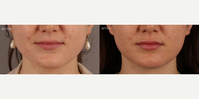 Lip Filler and Non-Surgical Jawline Slimming - 24-year-old female who expressed the desire for more lip symmetry, volume and shape. She also presented with a history of nighttime grinding and clenching, leading to significant pain and discomfort. She noted that this also correlated with enlarged masseter (chewing) muscles, making her jaw look wider. She is shown 2 weeks after masseter Botox, to treat her symptoms and narrow her jawline, and lip filler (Restylane Kysse) to her upper and lower lip. For the jawline, this is an early, subtle result, as it typically takes a full 6 weeks to see maximal jawline slimming.