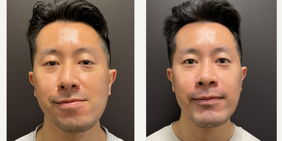 35-44 year old man treated with Jaw Surgery - Double jaw surgery to fix a significant malocclusion and asymmetry.