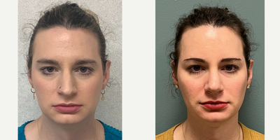 25-34 year old woman treated with Adam's Apple Reduction, Forehead Reduction, Brow Lift, Rhinoplasty, Septoplasty - this is a young lady who underwent facial feminization surgery including chin reduction, cleft reduction.